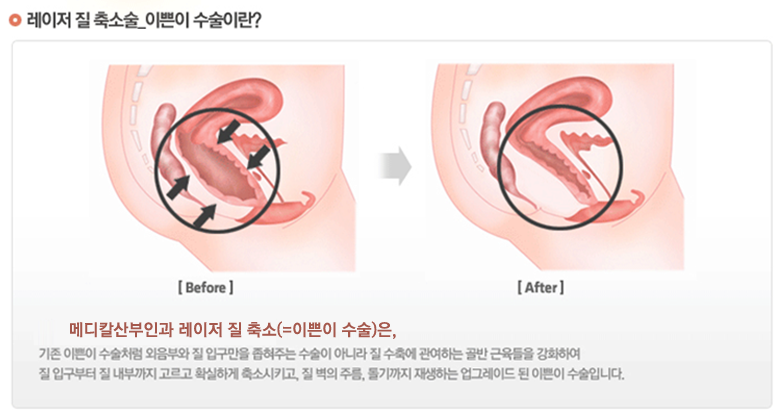 레이저 질 축소술